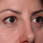 Blepharoplasty and Brow Lift Before & After Patient #34363